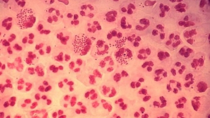 Study Says Gonorrhea Is Becoming Resistant to Antibiotics