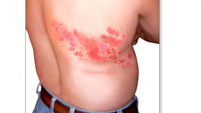 Shingles could increase risk of heart attack and stroke