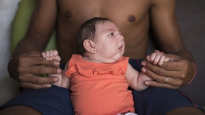 Zika virus blamed for brain damage in Hawaiian newborn