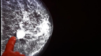 Genetic testing proves popular among women with breast cancer