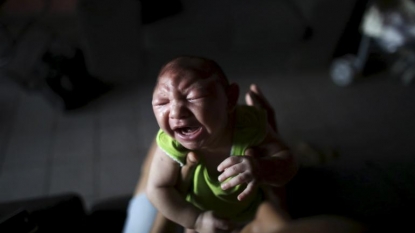 Zika suspected in stillbirth, other birth defects in Brazilian baby