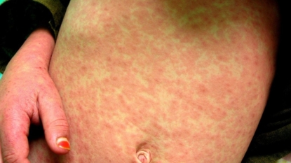 Arkansas officials urge measles awareness after 6 cases confirmed in Memphis