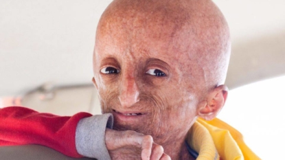 Progeria kid dies at 15 in Telangana