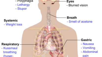 ADA: Liraglutide Lowers Risk for Cardiovascular Events in T2DM