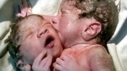 Rare conjoined twins born in Mumbai’s Sion Hospital