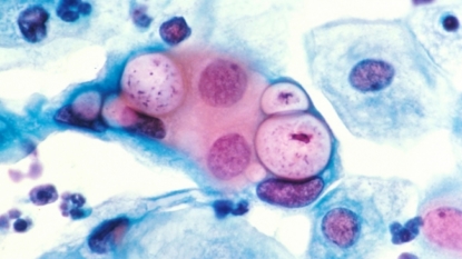 Researchers identify potential vaccine for chlamydia