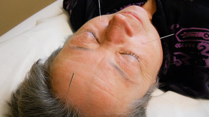 Can acupuncture improve dementia symptoms?