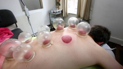 Cupping Like an Olympian