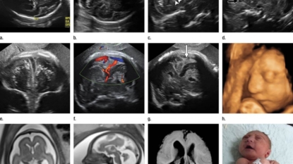 Tapeworm drug may treat Zika infection