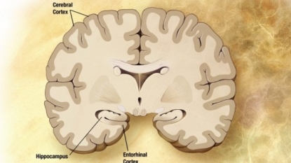 Biogen’s aducanumab Fast Track’d for Alzheimer’s disease