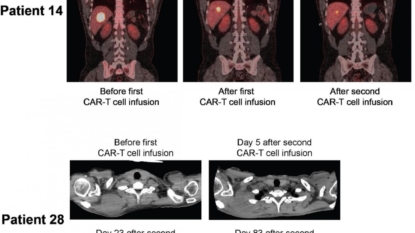 Cell Therapy Puts Advanced Lymphoma into Remission